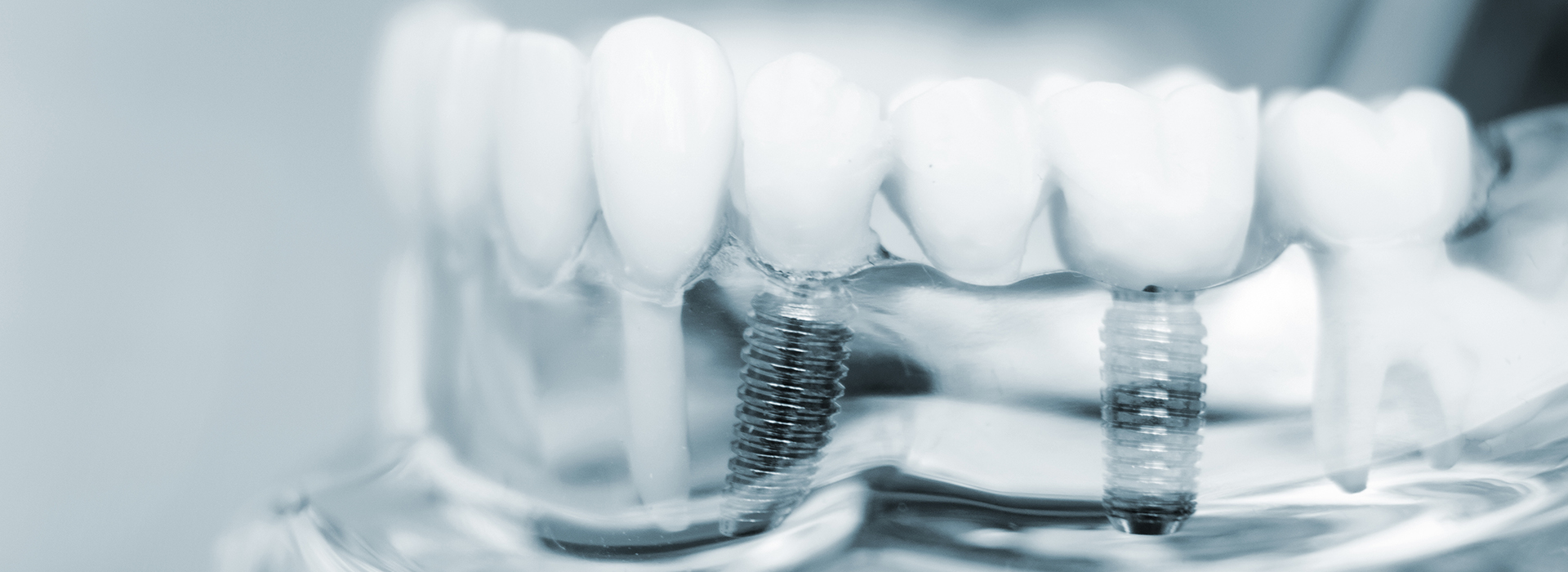 Bronx Wellness Family Dental | Implant Dentistry, Extractions and Veneers
