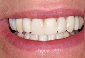 Bronx Wellness Family Dental | Cosmetic Dentistry, Veneers and Dental Fillings